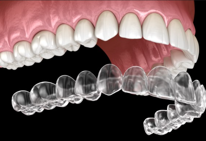 Clear Aligners